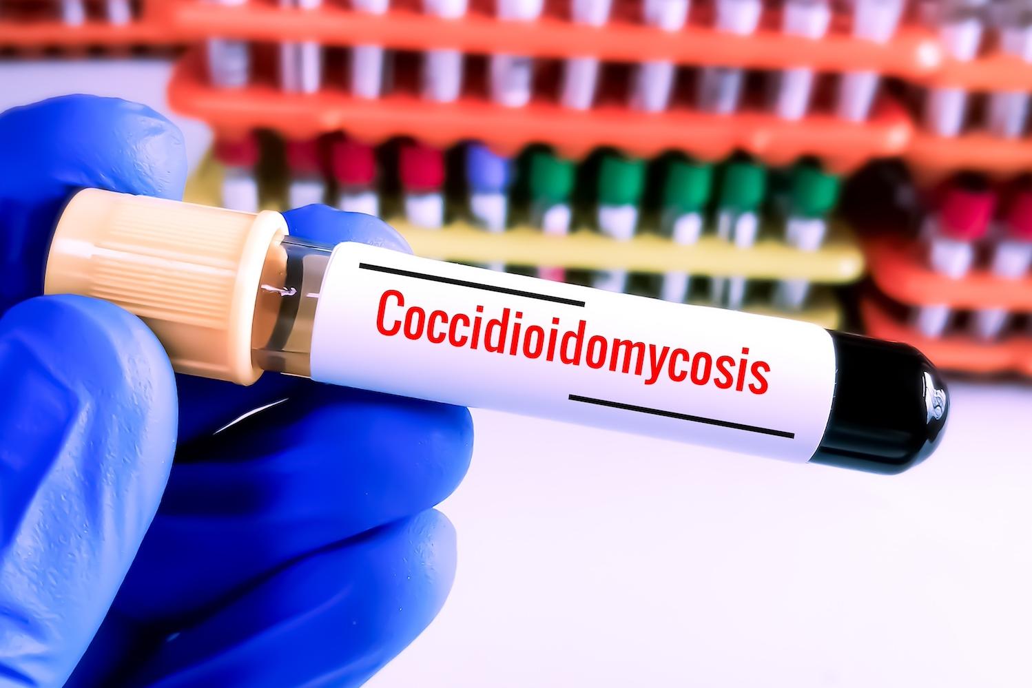 A gloved hand holds a vial of blood labeled "coccidioidomycosis," the scientific name for Valley Fever.